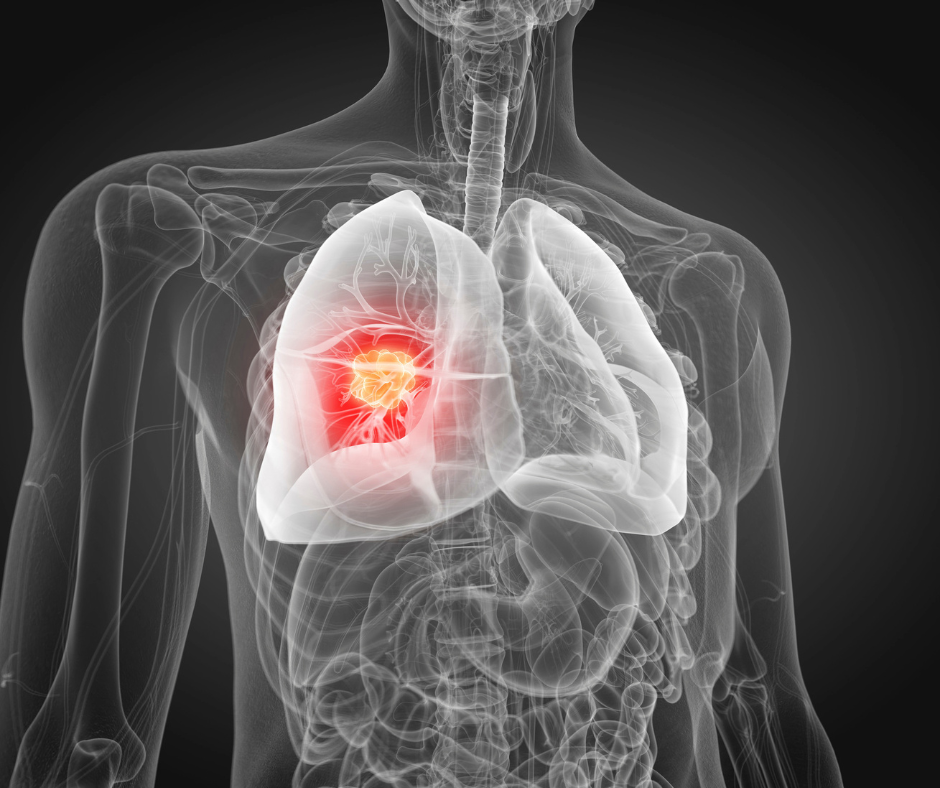 Closeup of chest with red area of lungs to illustrate lung cancer